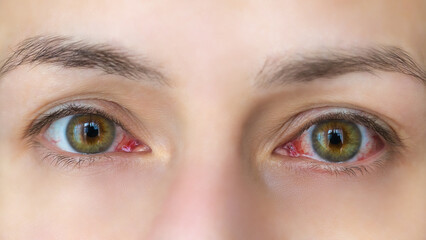 Close-up of a young woman with red eyes. Conjunctivitis