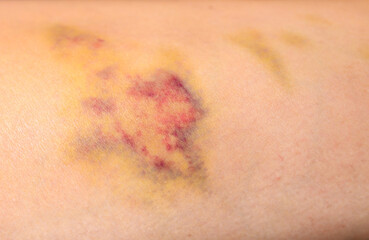 Bruises on the human body. Severe bruise from impact, bruising and hematoma.