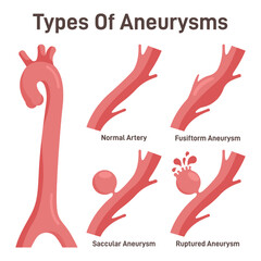 Thoracoabdominal aortic aneurysms types. Healthy aorta and aorta
