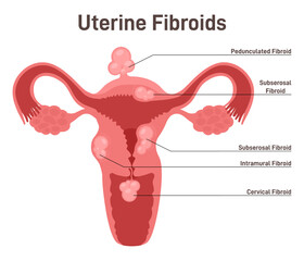 Uterine fibroid. Subserosal, intramural, submucosal and pedunculated