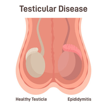 Epididymitis. Inflammation of the coiled tube at the back of the testicle.