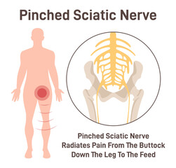 Sciatica. Pinched sciatic nerve causing pain and inflammation in pelvis