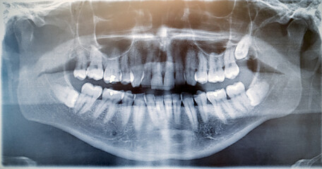 X ray image of wisdom tooth develops in a sac within the lower jawbone on both sides. Surgery,...