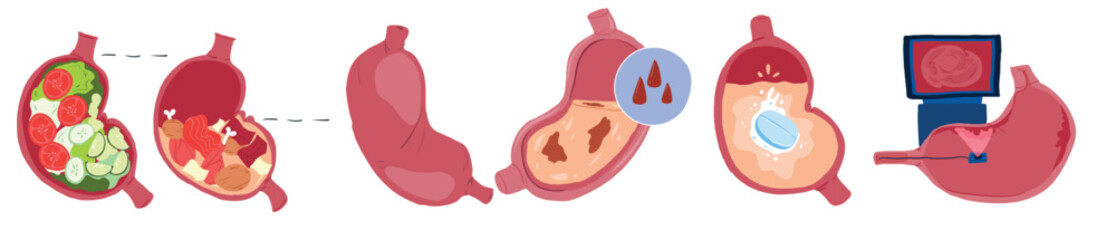 Set of different states of a sick and healthy stomach, proper nutrition and diagnosis. Vector flat cartoon illustration icon. Isolated on white background. Stomach feeling cartoon concept