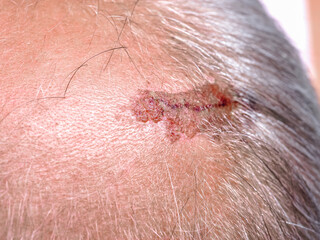 Bloody scar on a man's head