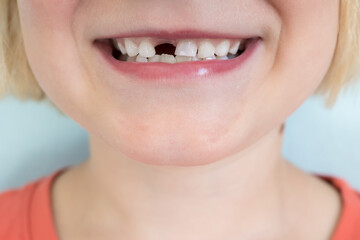 Child lost a deciduous teeth, close-up. Smiling kid without one tooth.