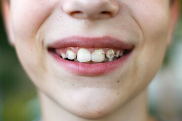 open mouth of a child boy with plaque or calculus on the teeth close. oral hygiene concept