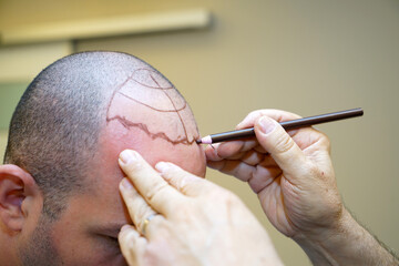 The man without hair is skin marked by the doctor at the hair transplant center for the place to be transplanted. sapphire techniques. Patient suffering from hair loss in consultation with a doctor.