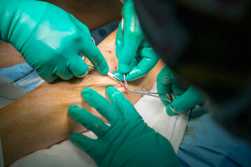 Process of varicose vein surgery in hospital, operating room, vein sealing, venous vascular surgery...