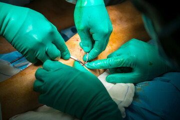 Process of varicose vein surgery in hospital, operating room, vein sealing, venous vascular surgery...