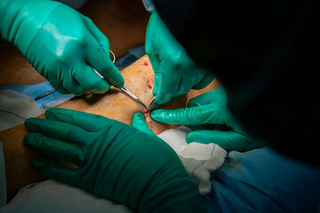 Process of varicose vein surgery in hospital, operating room, vein sealing, venous vascular surgery...