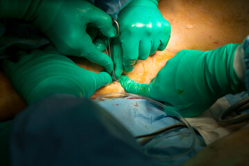 Process of varicose vein surgery in hospital, operating room, vein sealing, venous vascular surgery concept