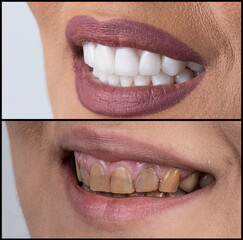 Fototapeta premium dental job photography, crowns veneers implants