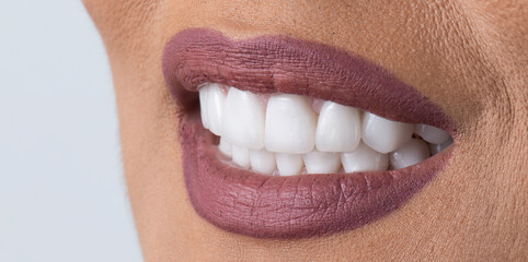 dental job photography, crowns veneers implants