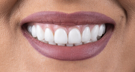 Fototapeta premium dental job photography, crowns veneers implants