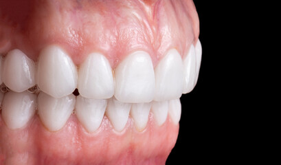 dental job photography, crowns veneers implants