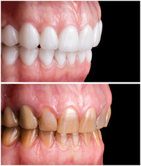 dental job photography, crowns veneers implants