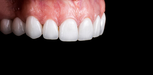 dental job photography, crowns veneers implants