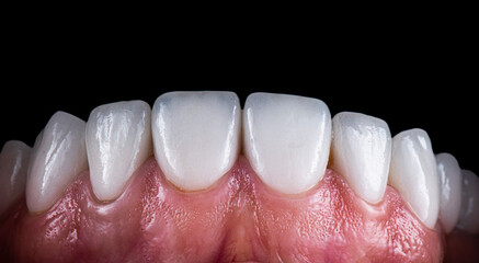 dental job photography, crowns veneers implants