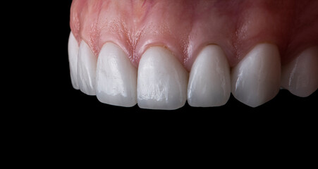 dental job photography, crowns veneers implants