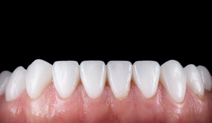 dental job photography, crowns veneers implants
