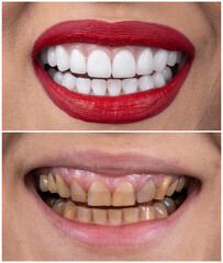 dental job photography, crowns veneers implants