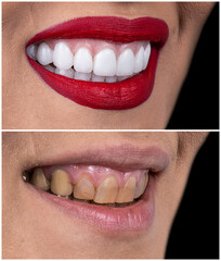 dental job photography, crowns veneers implants