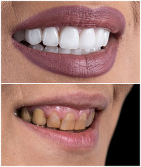 dental job photography, crowns veneers implants