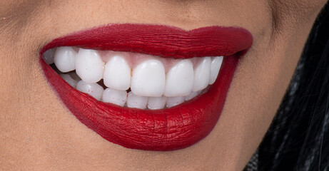 dental job photography, crowns veneers implants