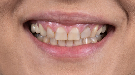dental job photography, crowns veneers implants