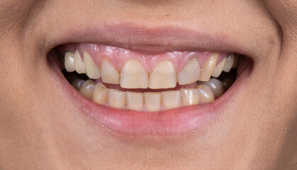 Naklejka premium dental job photography, crowns veneers implants