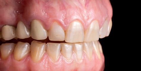 dental job photography, crowns veneers implants