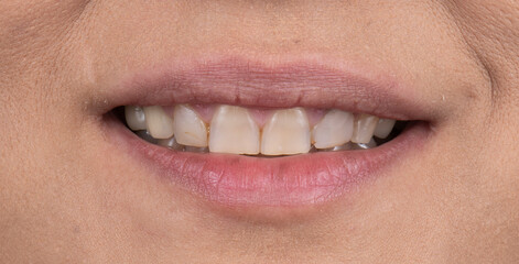 dental job photography, crowns veneers implants