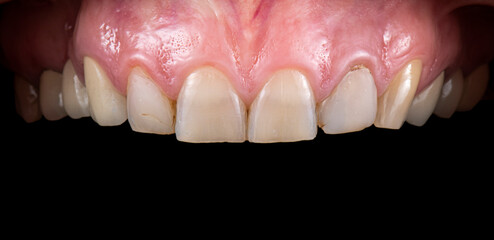 dental job photography, crowns veneers implants