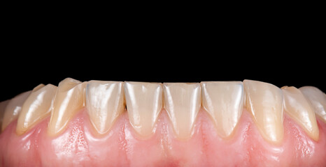 Fototapeta na wymiar dental job photography, crowns veneers implants