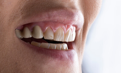 dental job photography, crowns veneers implants