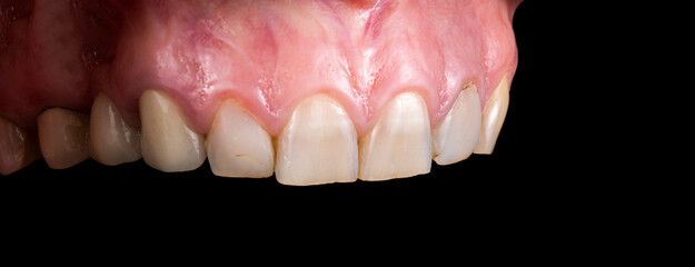 dental job photography, crowns veneers implants