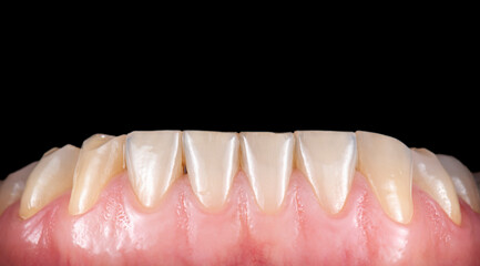 dental job photography, crowns veneers implants
