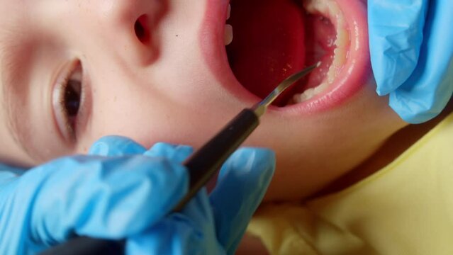 Open mouth child close-up at dentist, close up hands dentist who makes brushing teeth ultrasound. Female professional dentist at work. Dental checkup concept. Dentist work with children.
