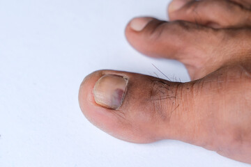 Fototapeta premium Toenail cuts and bruises. Concept illustration of the need for health care, pedology or dermatology