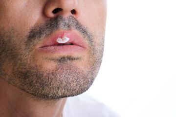 Obraz premium medical treatment with cold sore cream on a man's anonymous face