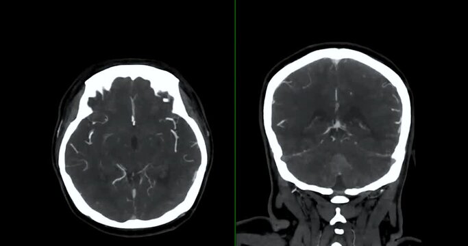 CTA brain or Computed tomography angiography of the brain comparison axial and coronal  plane for finding Stroke and aneurysm disease .