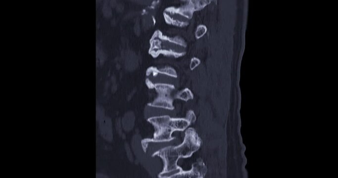 CT myelography or myelogram from computed tomography (CT-scanner) to look for problems in the spinal canal.