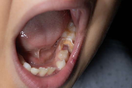 Destruction of a tooth by dental caries and disease