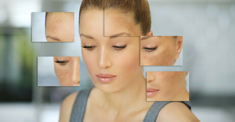 Dark spots, freckles,hyperpigmentation(melasma or chloasma),concept - skin lightening, skin...