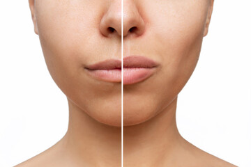 Result of lip augmentation. Young woman's lower part of face with lips before and after lip enhancement isolated on a white background. Injection of filler in lips