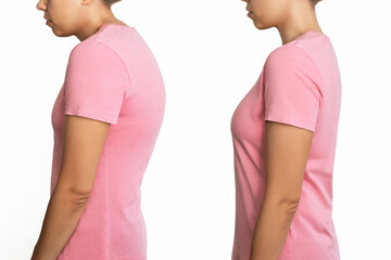 A young woman before and after treatment of scoliosis isolated on a white background. Correct and incorrect spine position. Slouching back and healthy spine. A posture before and after changing - obrazy, fototapety, plakaty