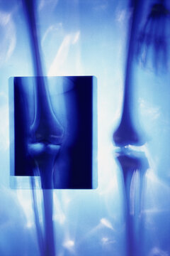 X-ray of a pair of human legs