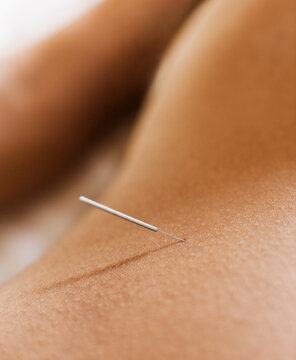 Woman Receiving Acupuncture. Koh Samui, Thailand.