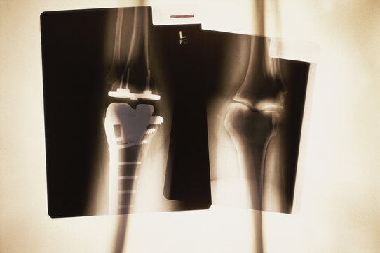 X-ray of a human leg with metal screws and rods